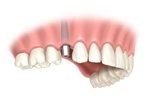 Dental implant for one tooth